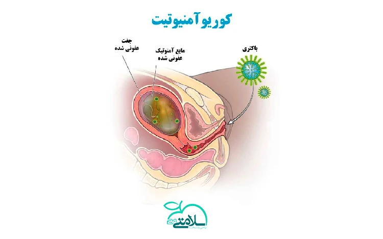 کوریوآمنیونیت یا عفونت کیسه آمنیوتیک